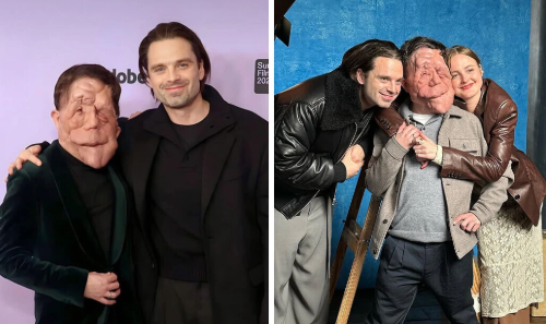 Top 10 World's Most Rare Conditions: Woman With Two Heads