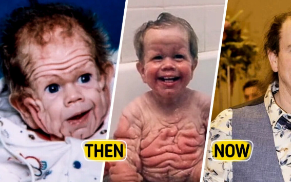 Top 10 World's Most Rare Conditions: Woman With Two Heads, An Old Man Baby, The Man With No Chin...