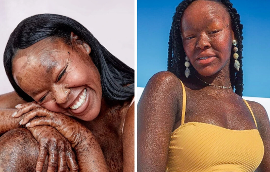 Top 10 World's Most Rare Conditions: Woman With Two Heads